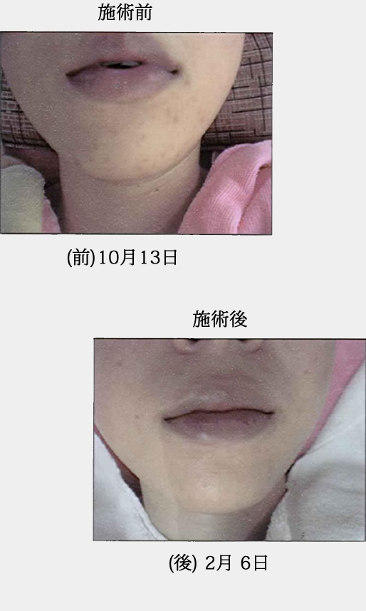 ニキビの改善と共にリフトアップで小顔の実現