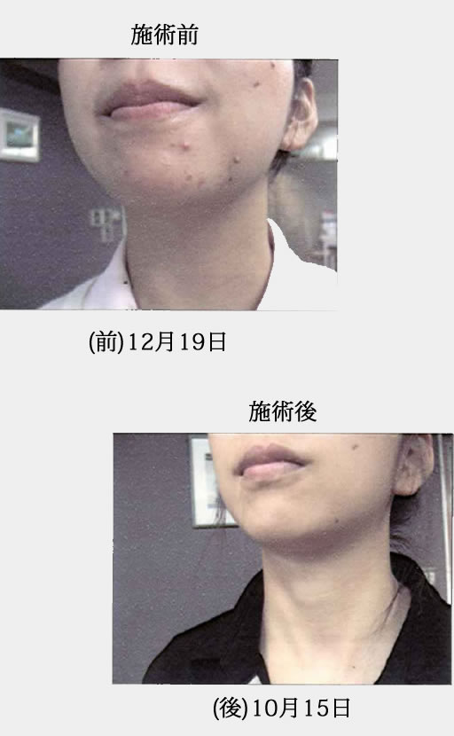 ニキビの改善と共にリフトアップで小顔の実現